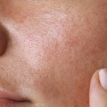 Understanding Oily Skin Type