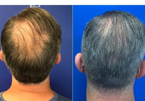 Are there any special skincare products for balding or thinning hair in men?